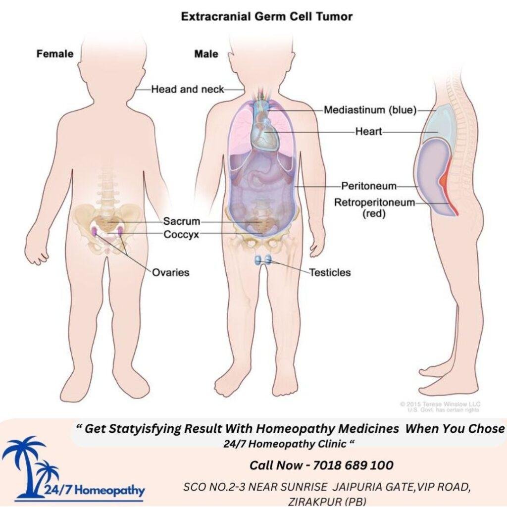 EXTRA GONADAL GERM CELL TUMOUR - 247homeopathy